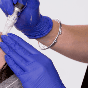 Microneedling; Collagen Induction Therapy